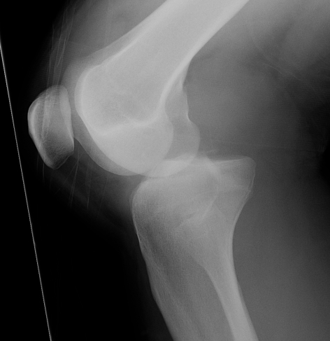 Posterior tibia knee dislocation